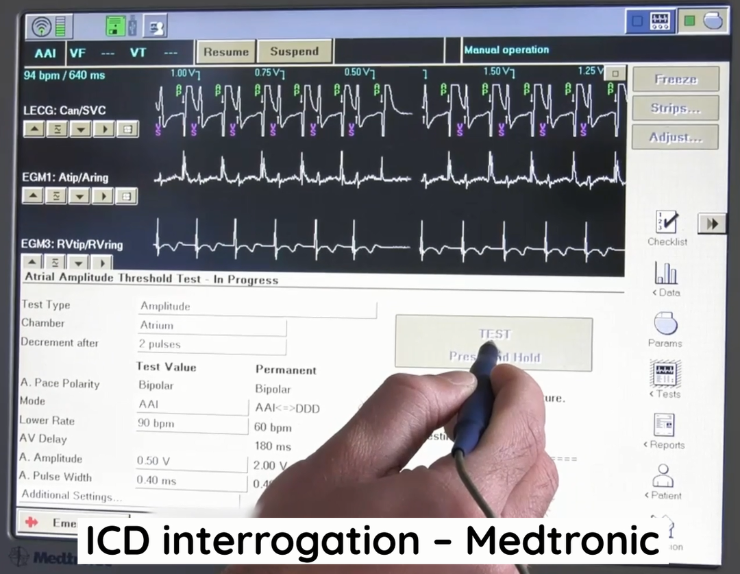 Workflow Blog ICD interrogation Medtronic